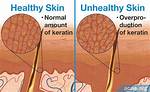What Causes Hyperkeratinization