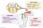 What Causes Hyporeflexia?