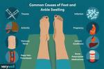 What Causes Instep Swelling?