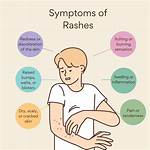 What Causes Linear Rashes