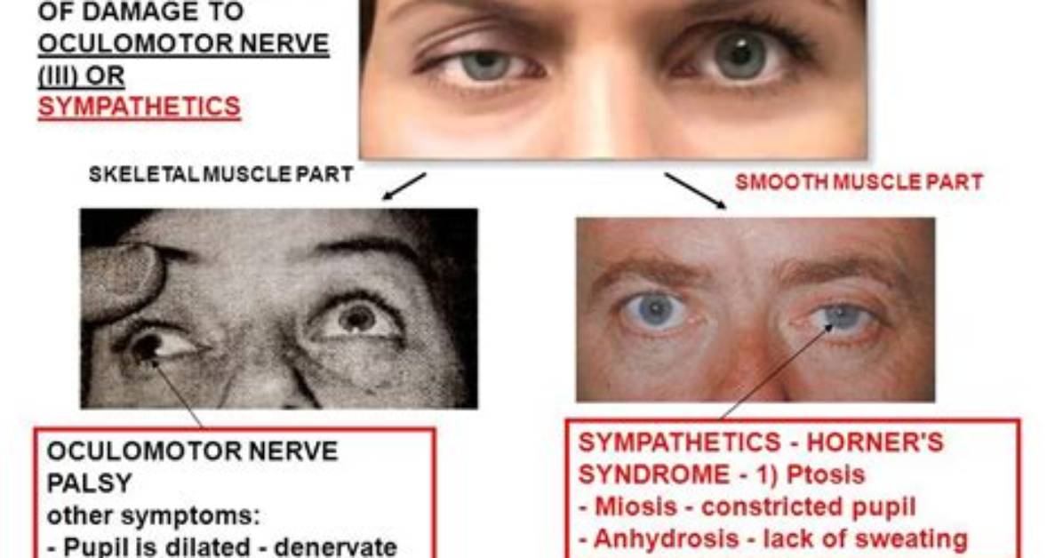 What Causes Oculomotor Dysfunction