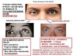 What Causes Oculomotor Dysfunction