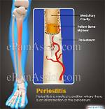 What Causes Periostitis