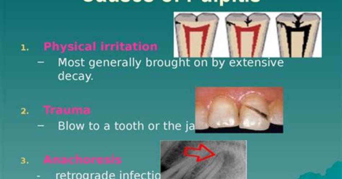 What Causes Pulpitis