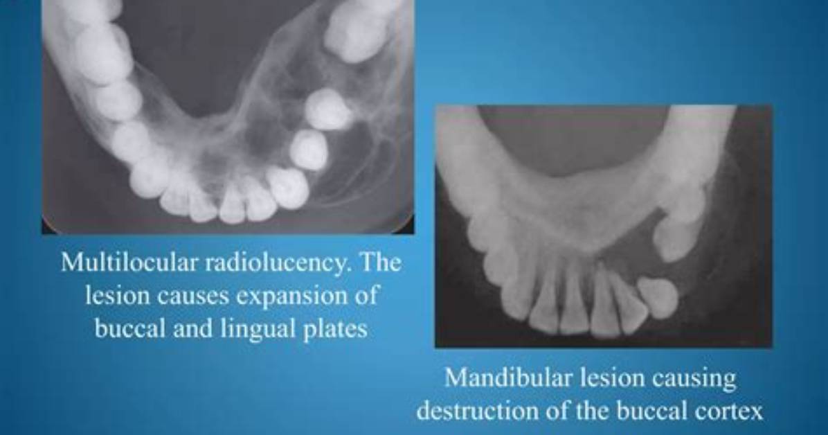 What Causes Radiolucency