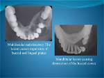 What Causes Radiolucency