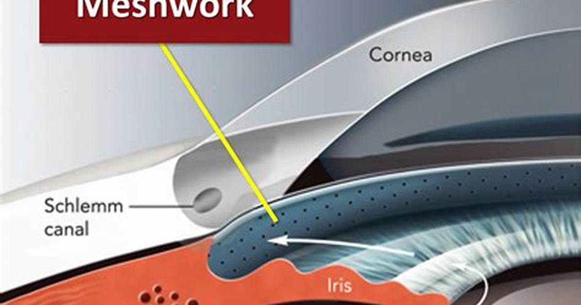 What Clogs Trabecular Meshwork?