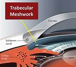 What Clogs Trabecular Meshwork?