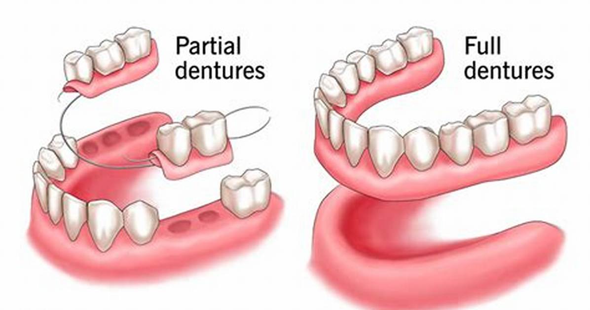 What Dentures Replace