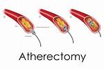 What Do Atherectomy Mean?