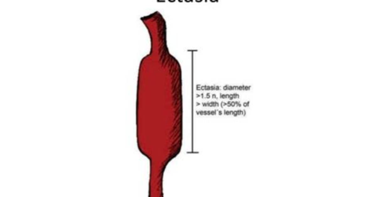 What Do Ectasis Mean?