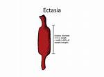 What Do Ectasis Mean?
