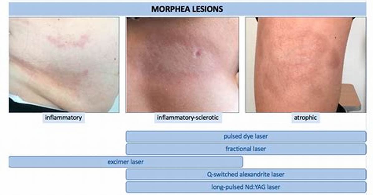 What Do Morphia Mean?