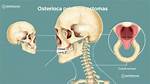 What Do Osteomas Feel Like?