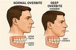 What Do Overbites Do?
