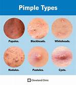 What Do Pimples Mean?