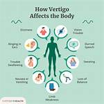 What Do Vertigo Mean?