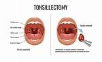 What Do You Wear to Tonsillectomy?