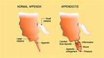 What Does a Busted Appendix Feel Like?