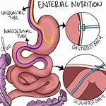 What Does a Enterotomy Do?