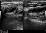 What Does a Fluid Filled Appendix Mean