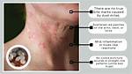 What Does a Mite Bite Look Like on a Human