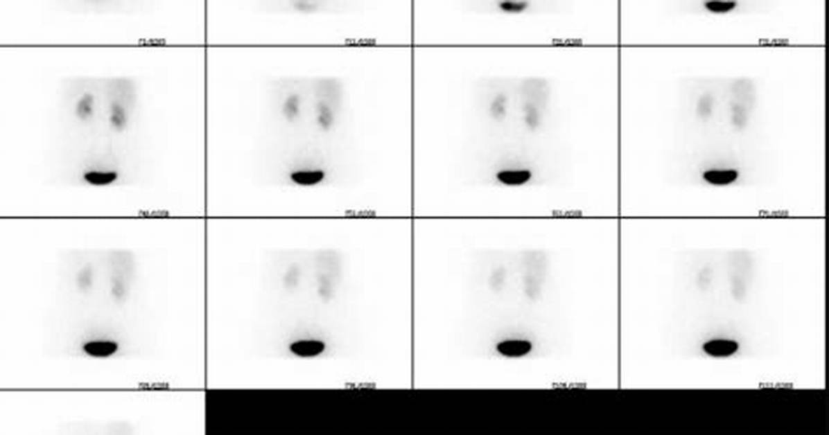 What Does a Renogram Show