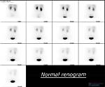 What Does a Renogram Show