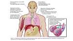 What Does Aerosinusitis Mean?