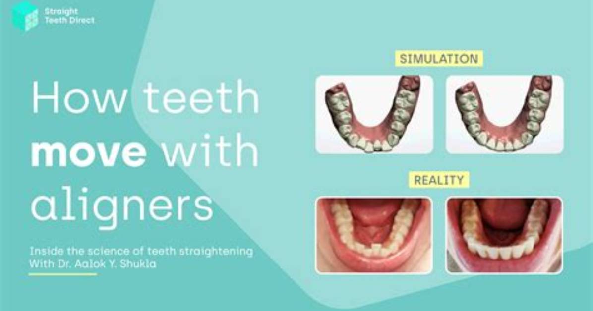 What Does Aligners Do for Teeth?