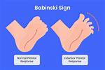 What Does Babinski Mean?