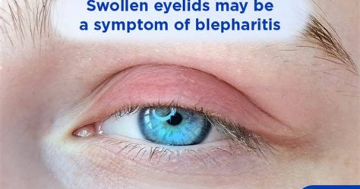 What Does Blepharedema Mean?