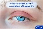 What Does Blepharedema Mean?