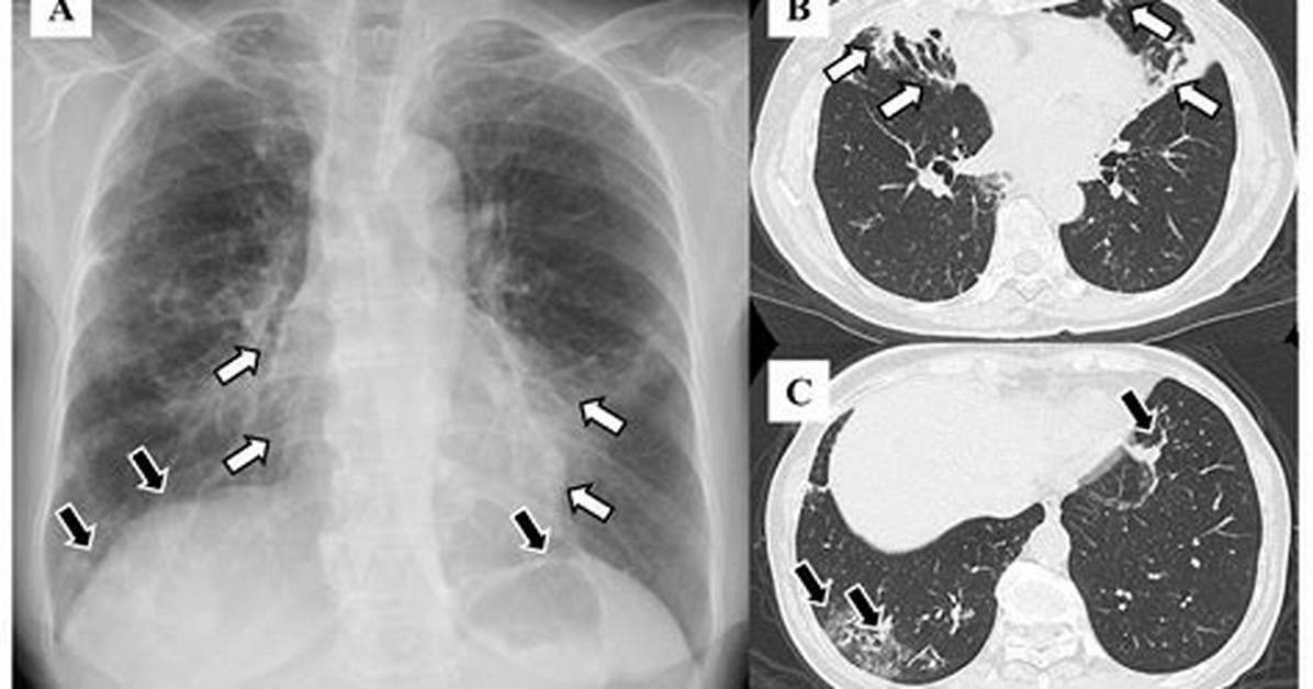 What Does Bronchiectatic Changes Mean?