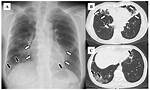 What Does Bronchiectatic Changes Mean?