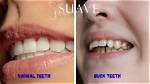 What Does Buck Tooth?