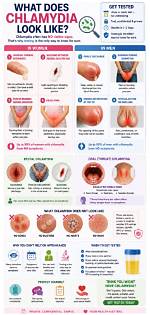 What Does Chlamydia Look Like?