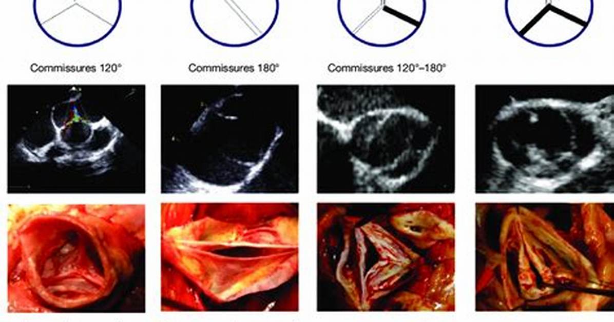 What Does Commissural Mean?