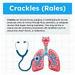 What Does Crackles Indicate?