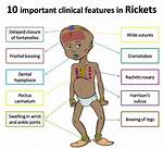 What Does Craniotabes Mean?