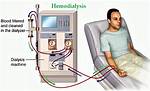 What Does Dialysis Do?