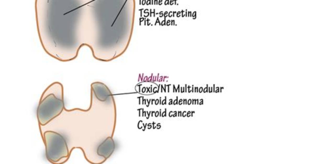 What Does Diffuse Goiter Mean