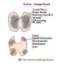 What Does Diffuse Goiter Mean