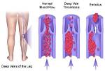 What Does Dvt Stand For