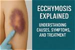 What Does Ecchymosis Indicate?