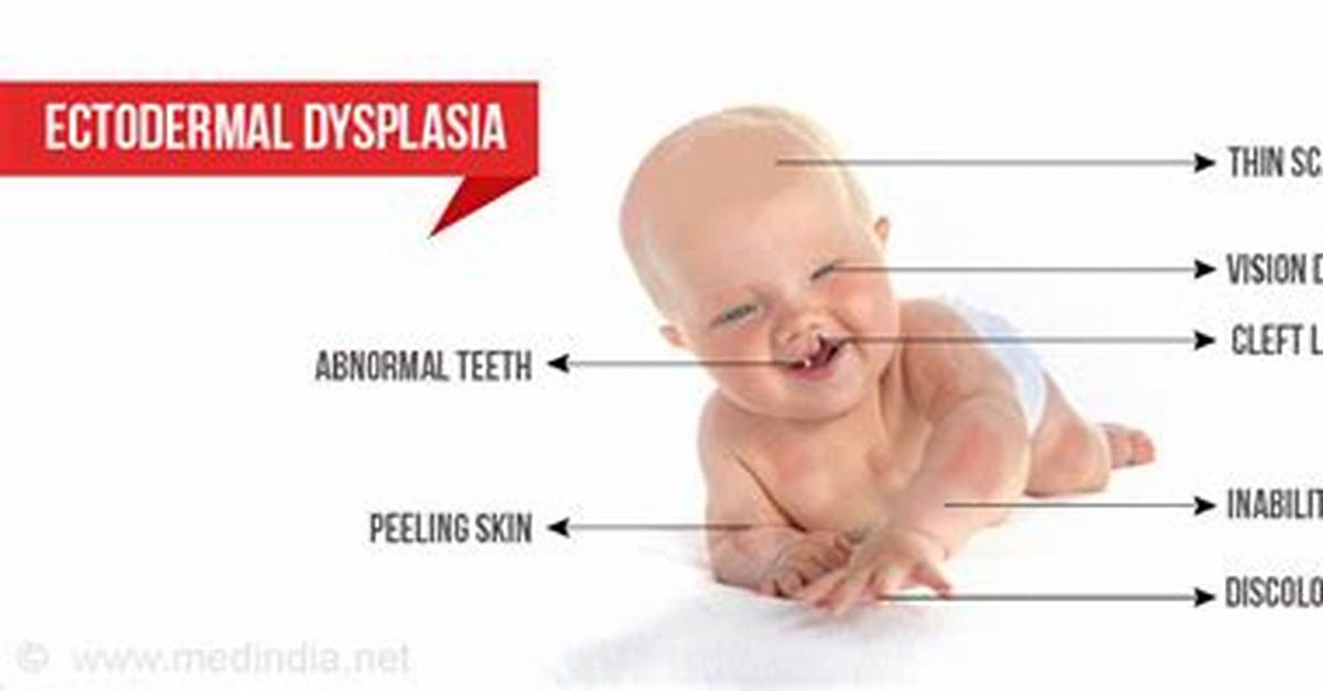 What Does Ectodermal Dysplasia Mean?
