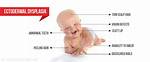 What Does Ectodermal Dysplasia Mean?
