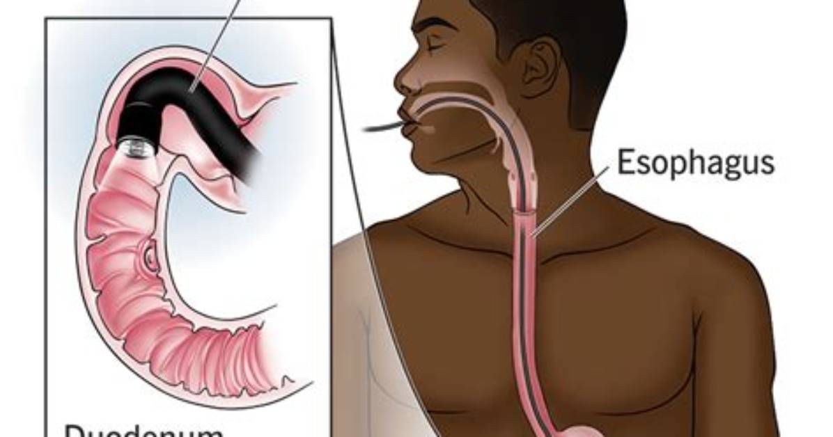 What Does Endoscopy Mean?