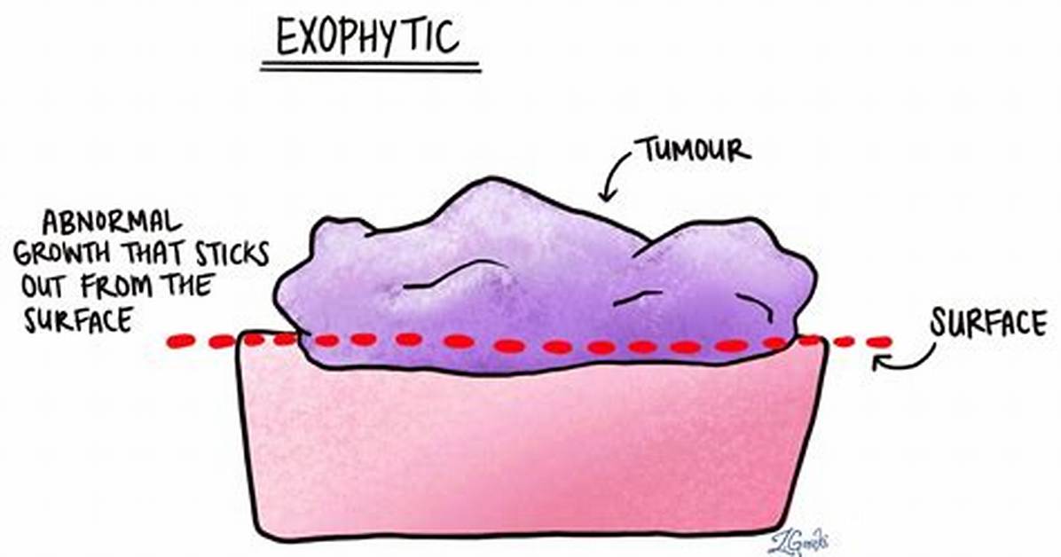 What Does Exophytic Mean?