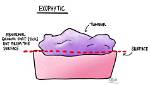 What Does Exophytic Mean?